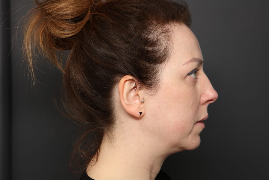 Profile Improvement Weak Chin Treatment At Define Medical Clinic Beaconsfield