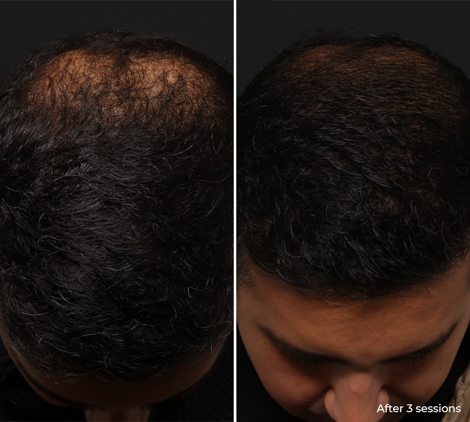 PRP at Define Medical Clinic Beaconsfield PRP at Define Medical Clinic Beaconsfield