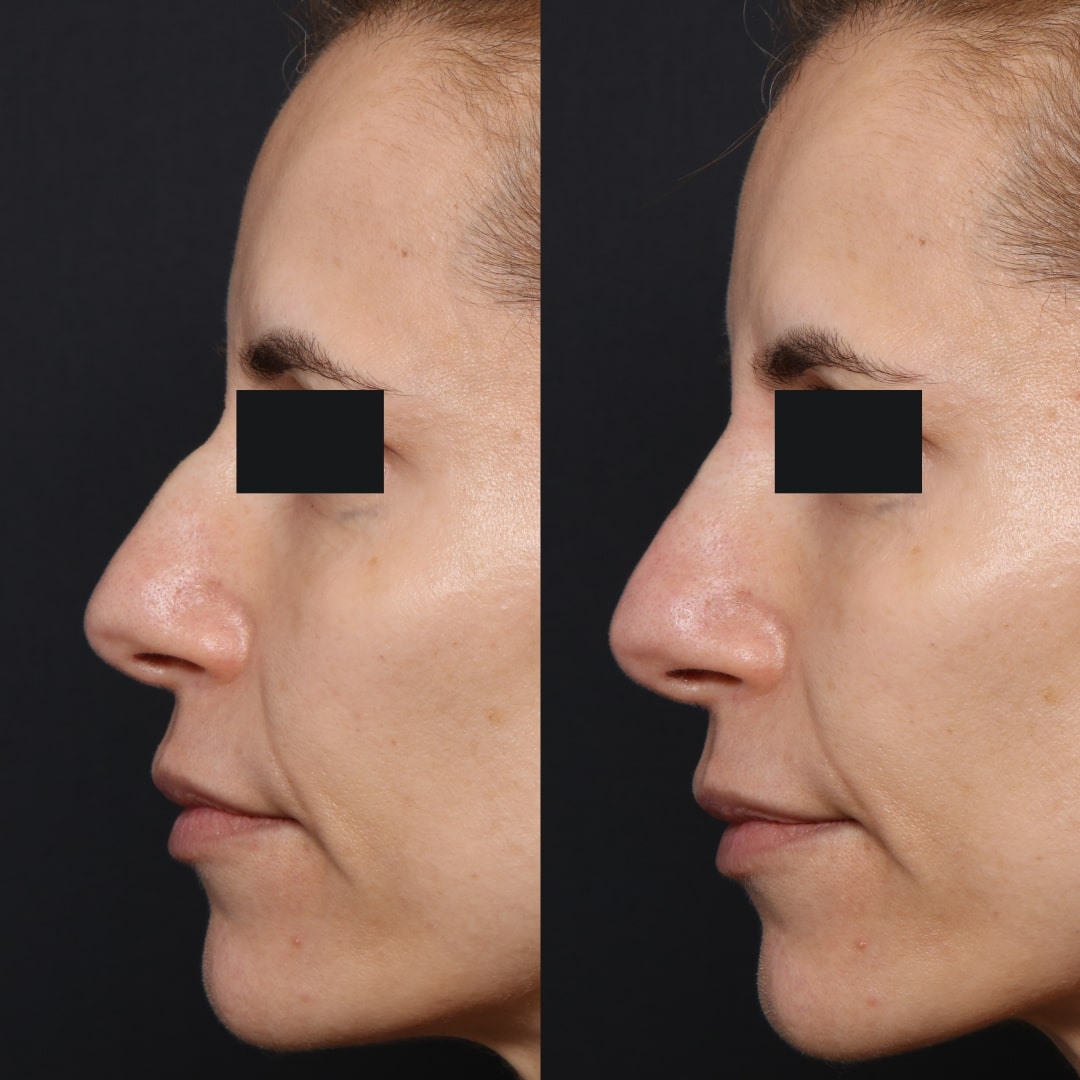 Non surgical rhinoplasty before and after