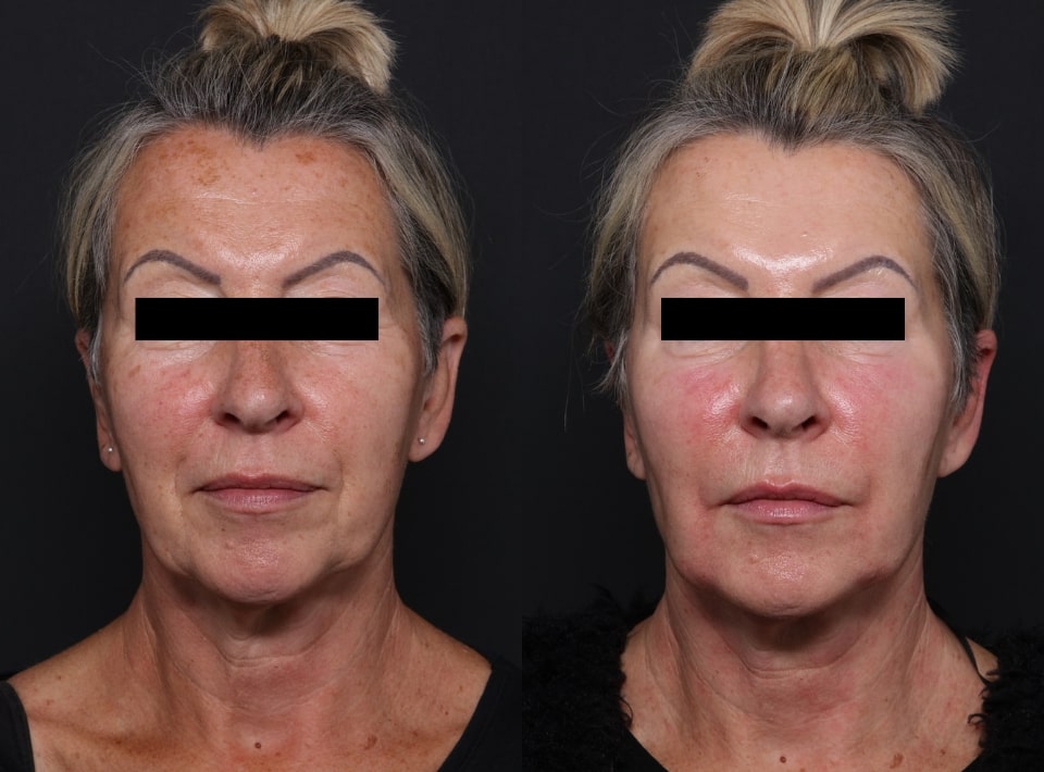 BBL Sciton before and after