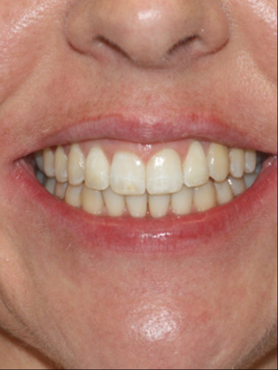 INVISALIGN