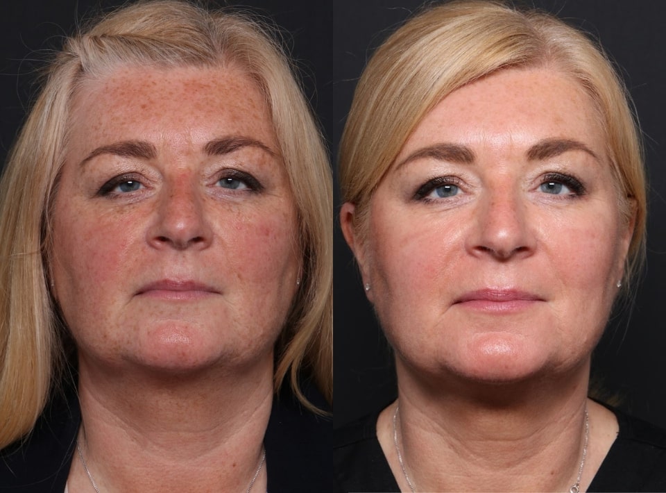 BBL Sciton before and after