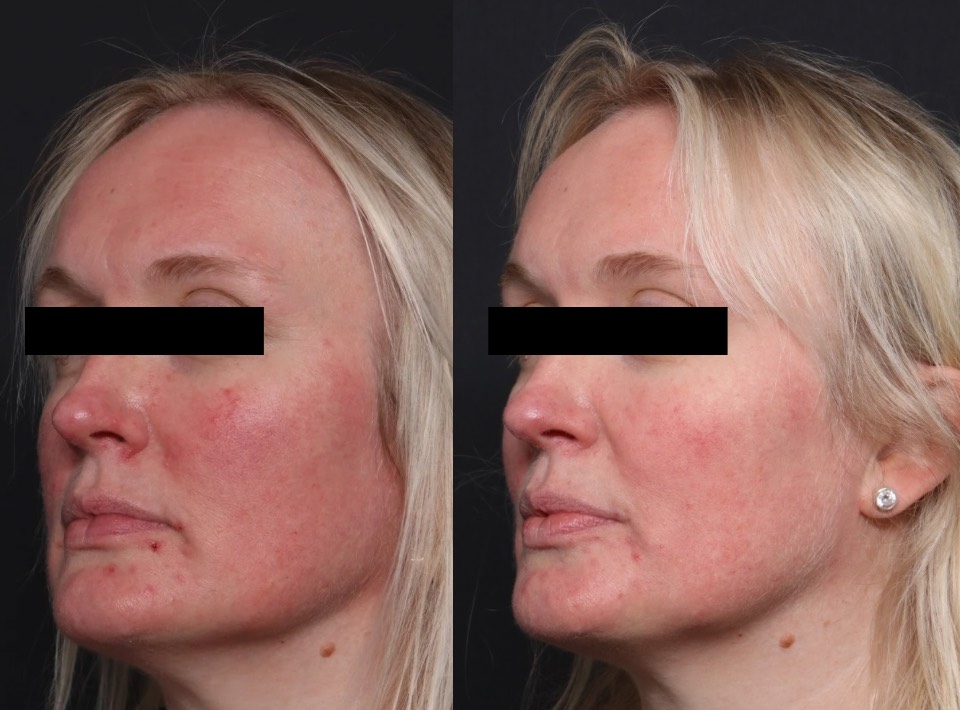 BBL Hero & Halo before and after for pigmentation on face