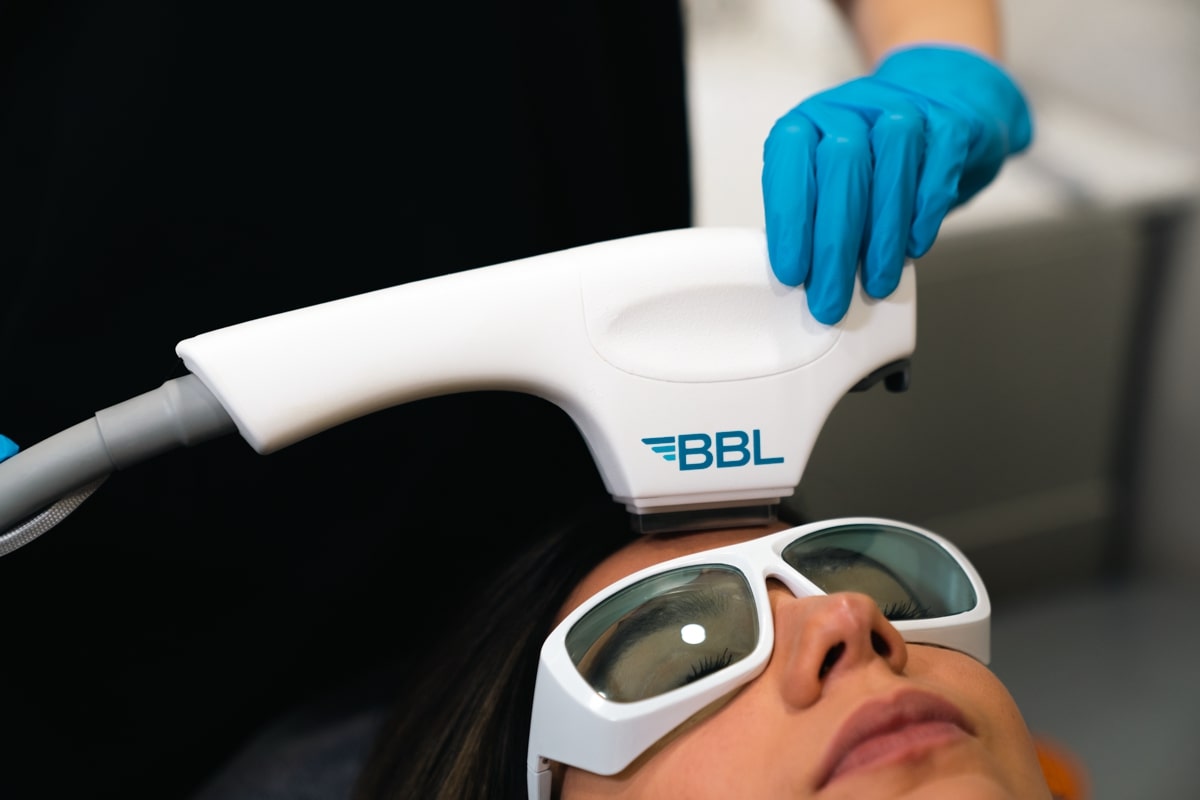 BBL Sciton treatment