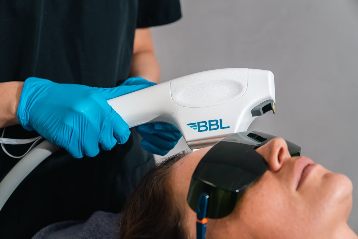 BBL Sciton treatment