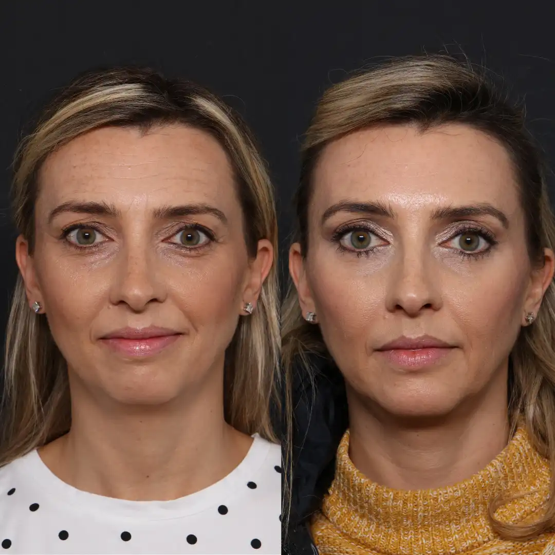 Botox London before and after face