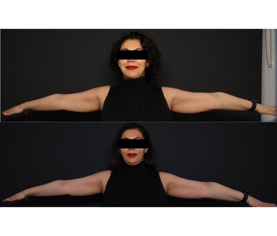 CoolSculpting - Under Arms