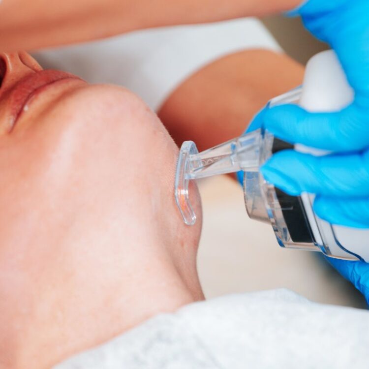 What You Need To Know Before Booking Laser Resurfacing In London