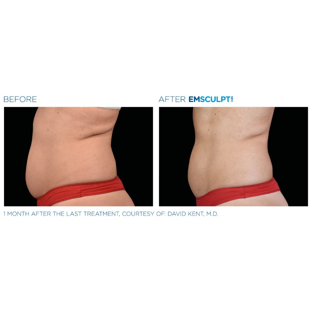 Emsculpt Neo before and after abdomen