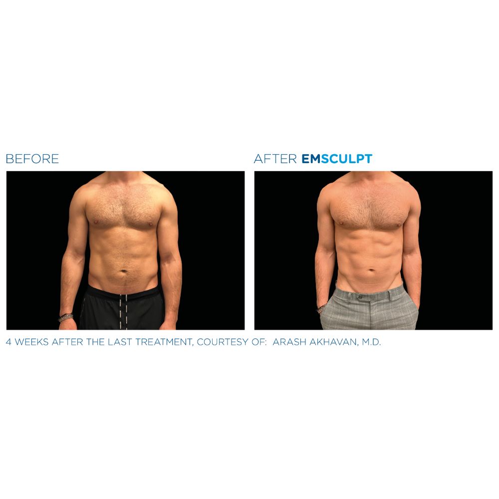 Emsculpt Neo before and after abdomen