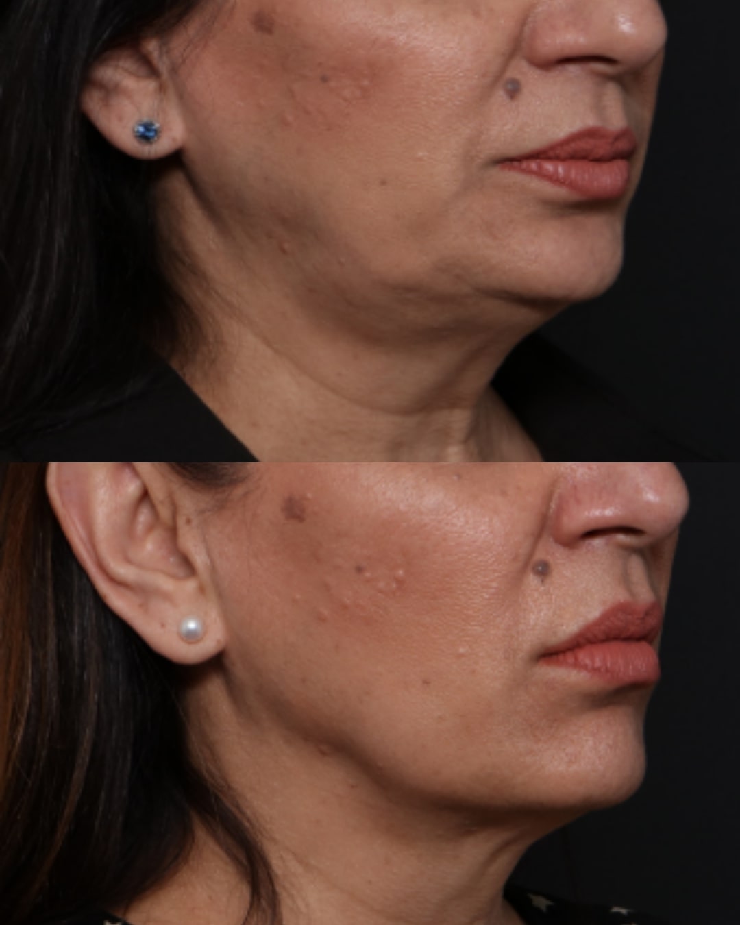 Exilis before and after jawline