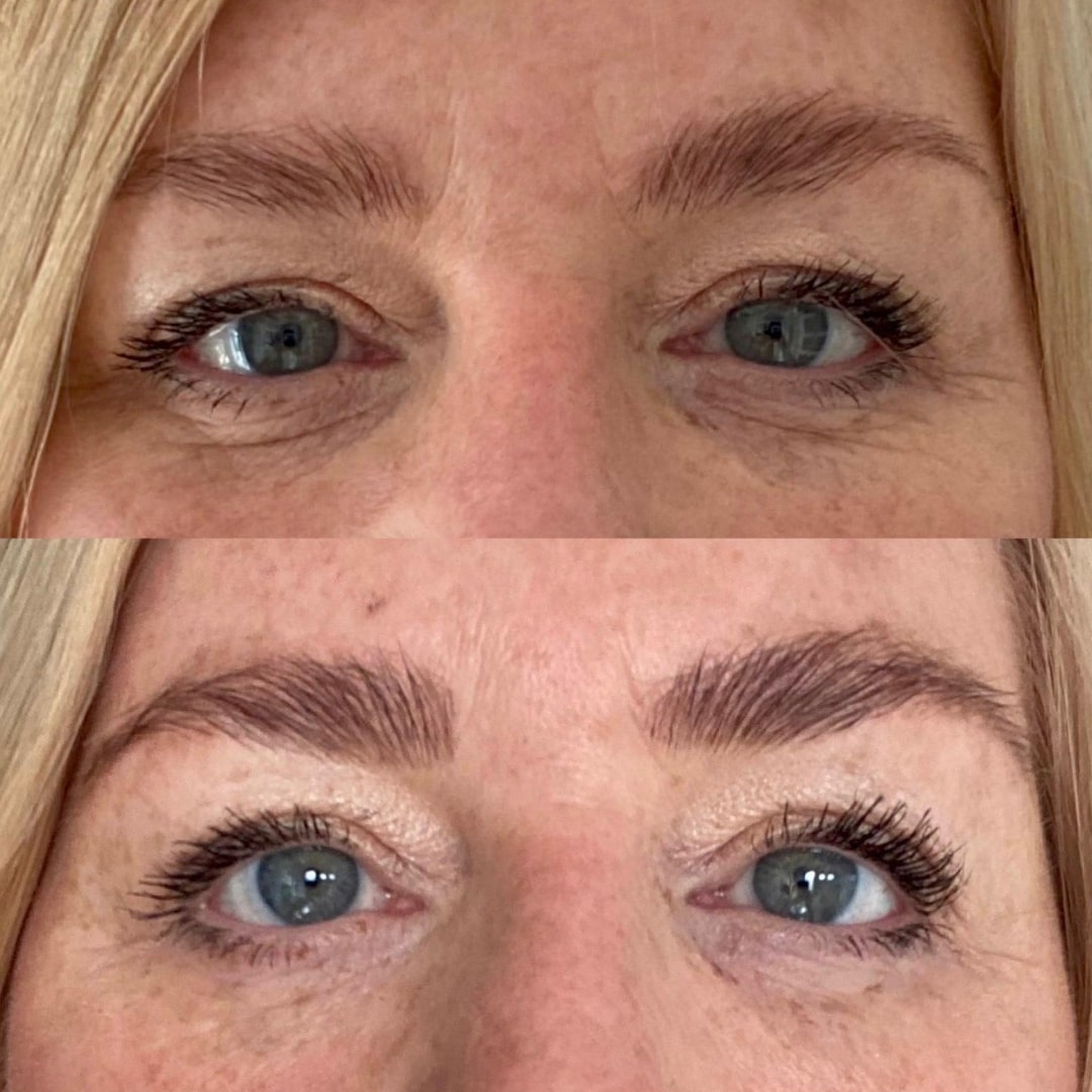 Ultraformer on the eyes before and after