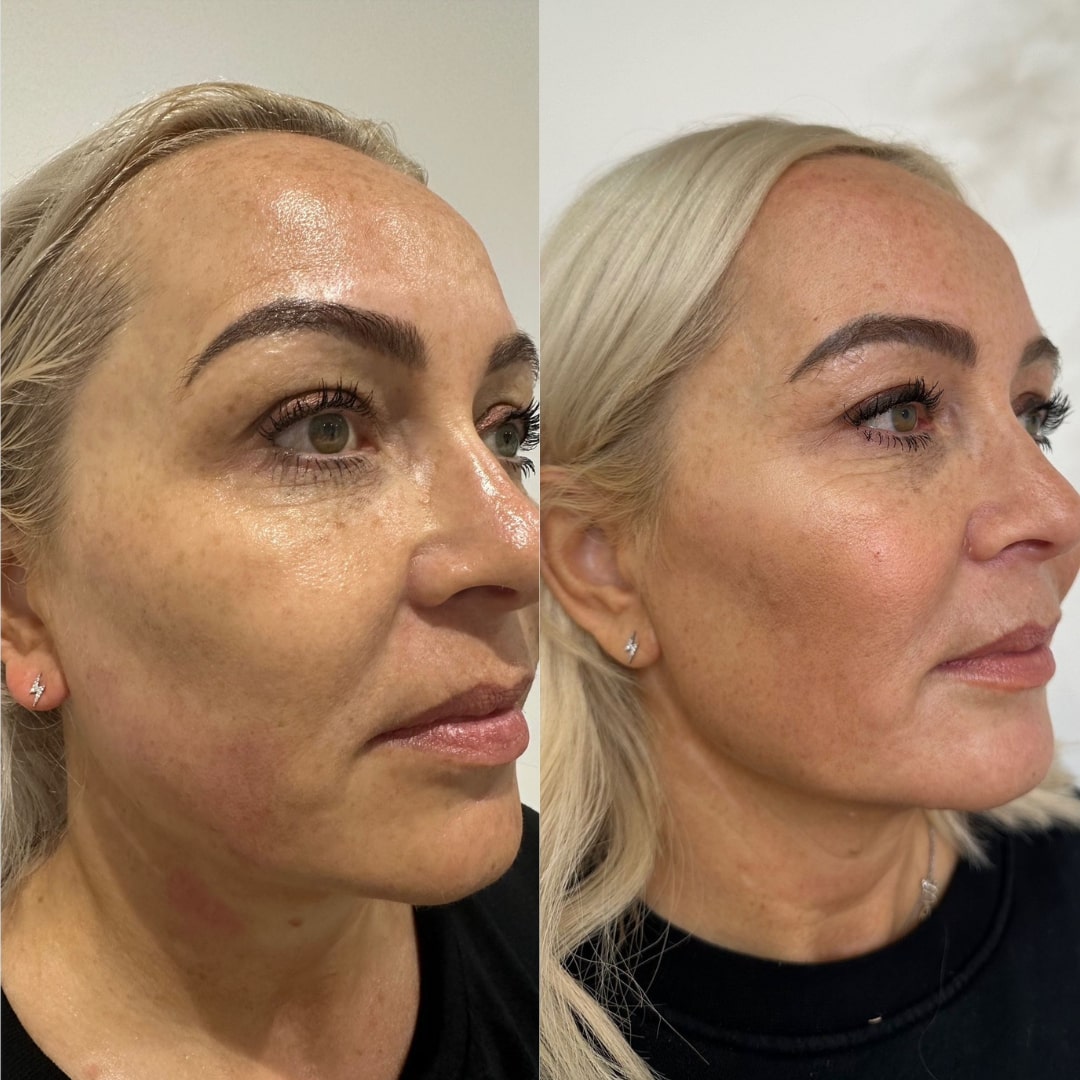 Ultraformer before and after