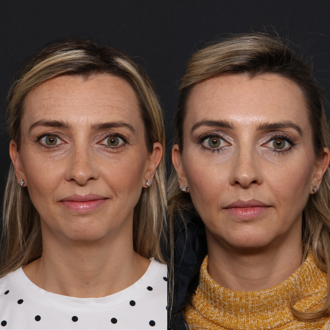 Botox London before and after face