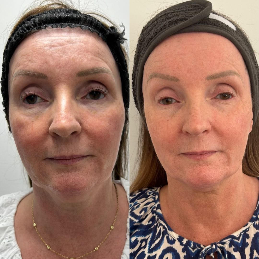 Ultraformer before and after