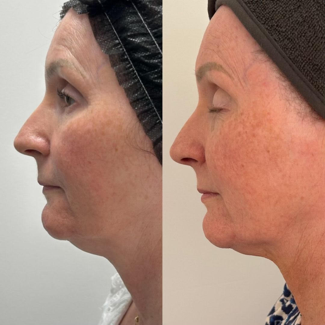 Ultraformer before and after