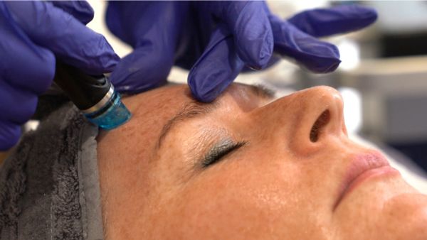 Hydrafacial treatment