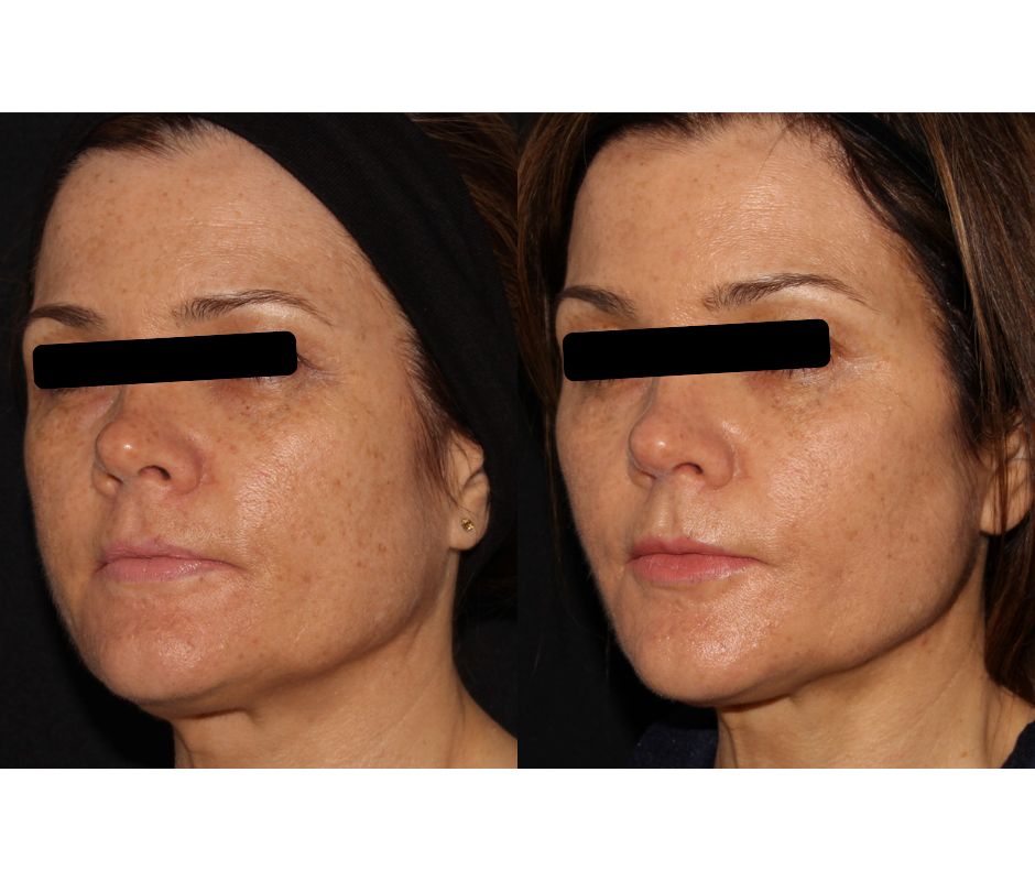 Liquid Facelift - Dermal Fillers