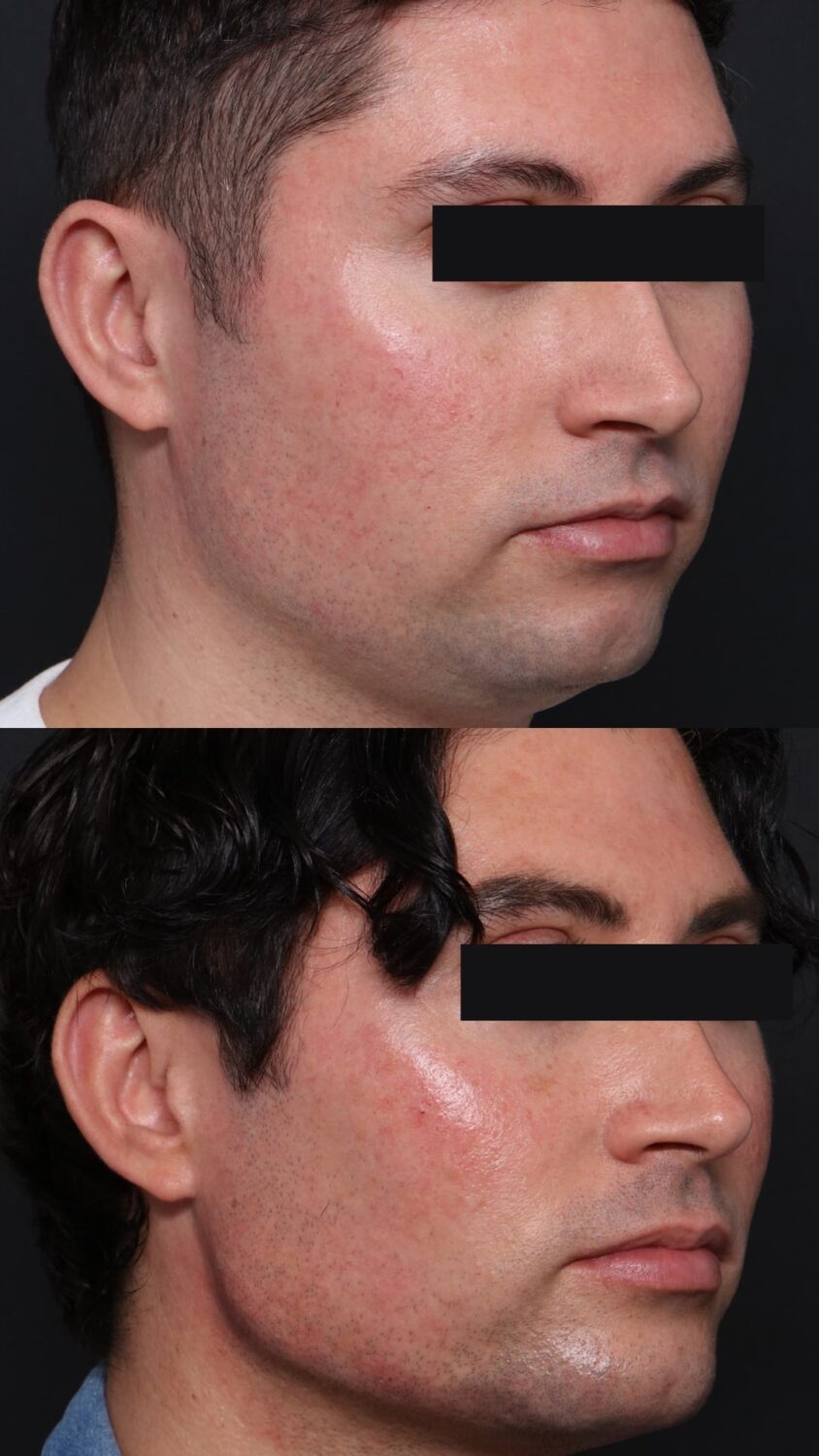Male jawline dermal fillers before and after