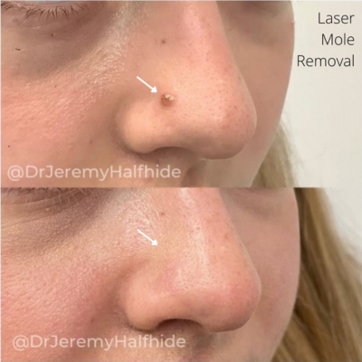 Mole Removal B&A