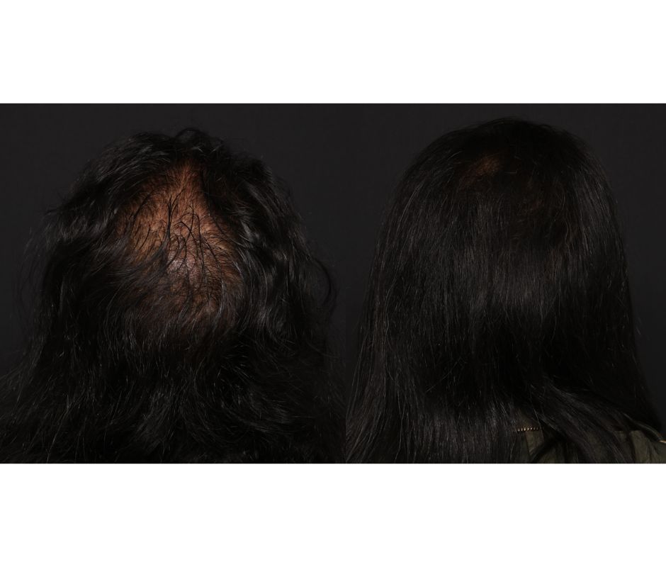 PRP - Hair (2)