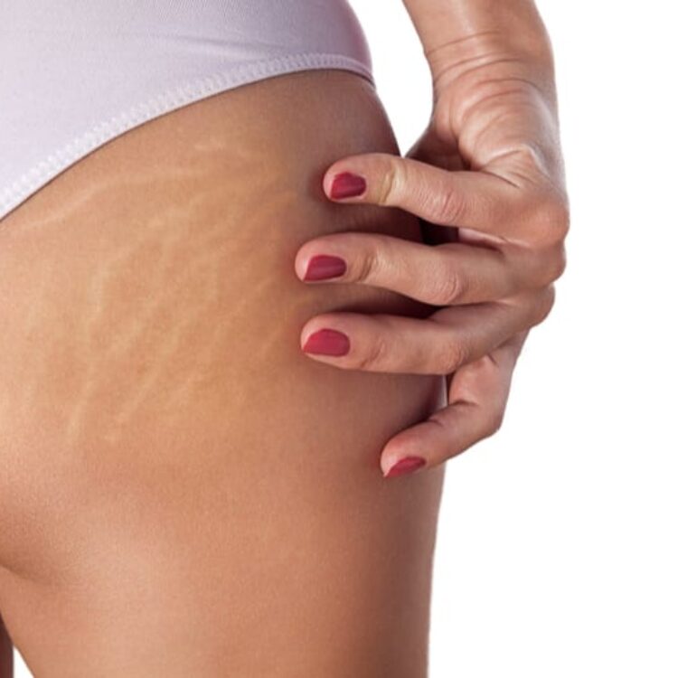 Stretch Marks And How To Deal With Them