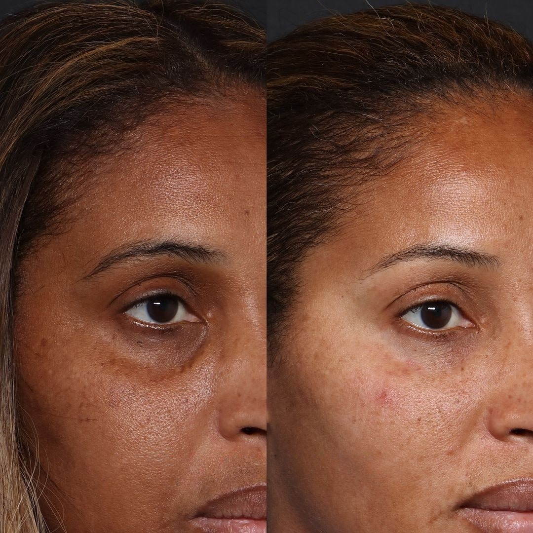 Tear trough dermal filler before and after