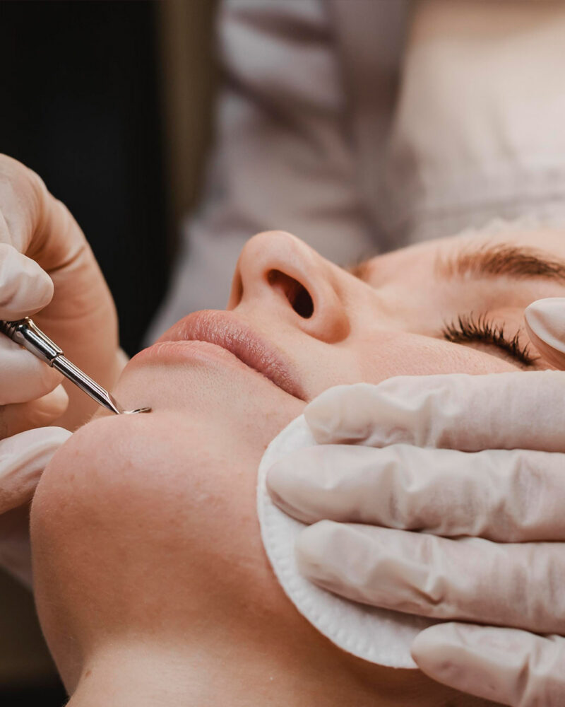 The Histology of Texture: Addressing Post-inflammatory Hyperpigmentation and Scarring through Controlled Dermal Remodelling