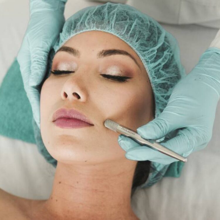 HIFU for Jowls and Lower-Face Lifting