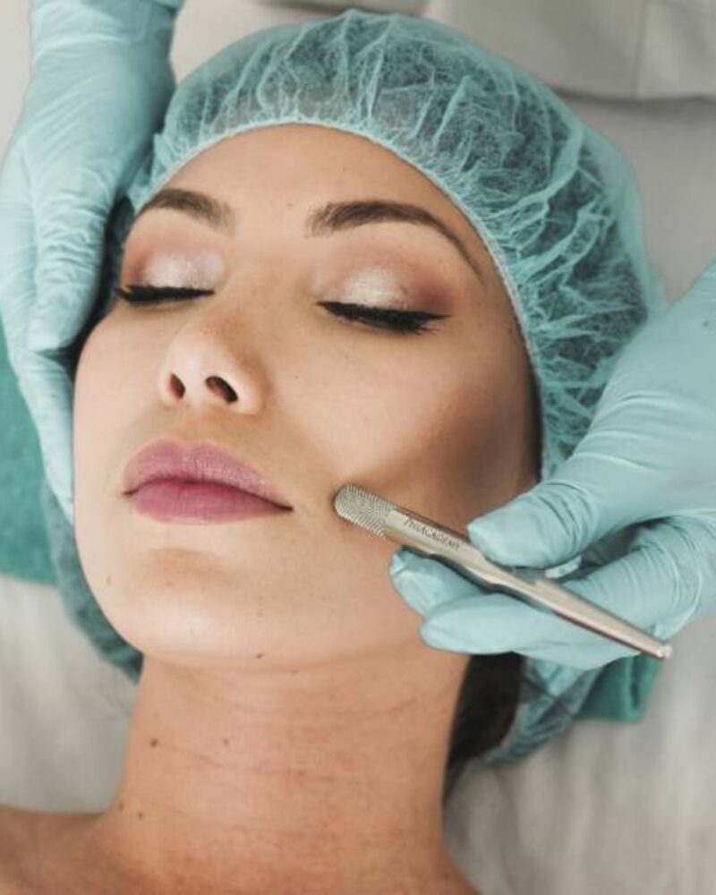 HIFU for Jowls and Lower-Face Lifting