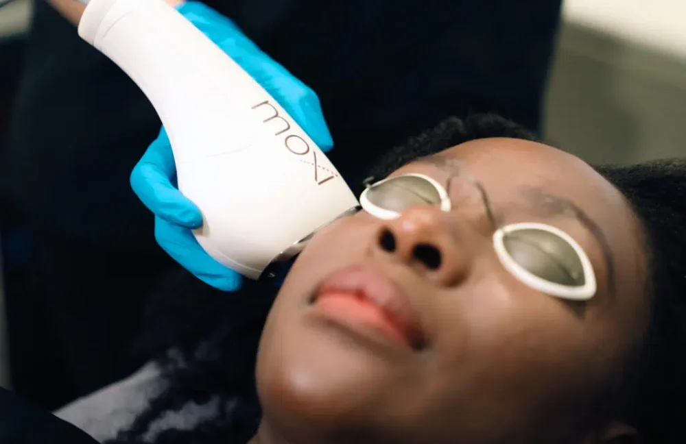 Laser Skin Resurfacing