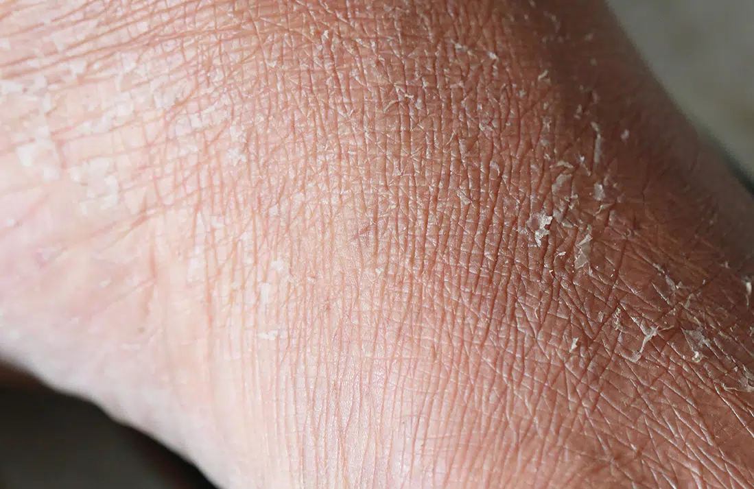 img-51.jpg Dehydrated Skin and Dull Skin