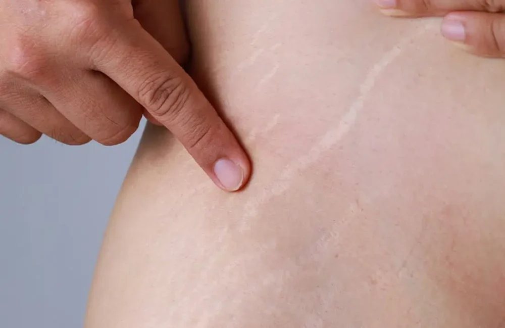 Stretch Marks