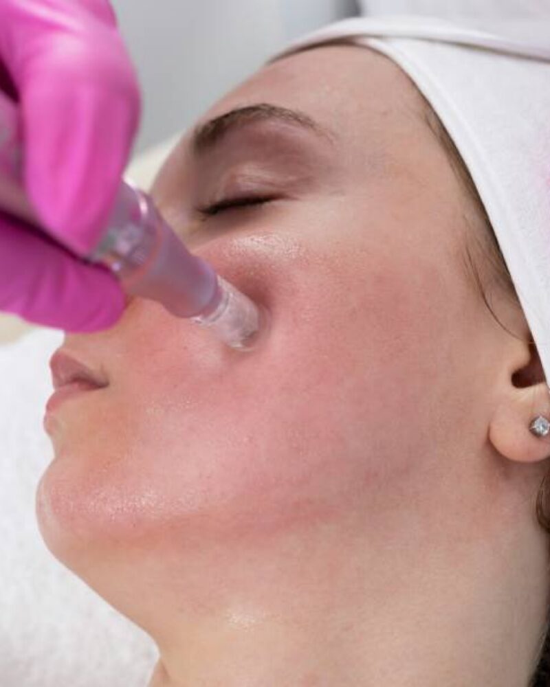 How Microneedling Triggers Collagen Induction