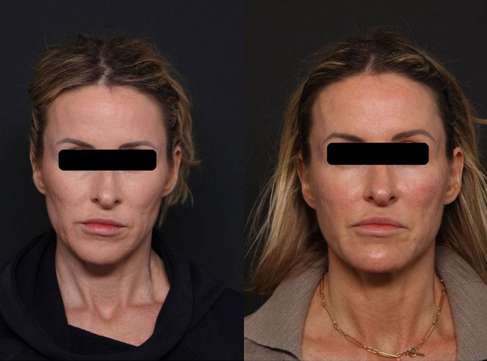 Sculptra Treatment