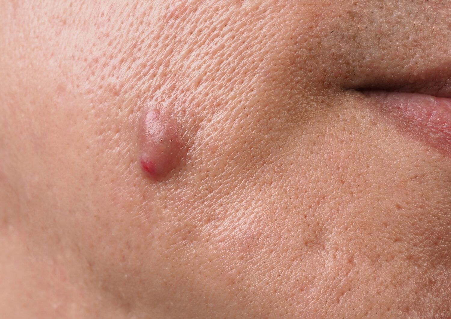 Mole Removal | Define Clinic London & Beaconsfield
