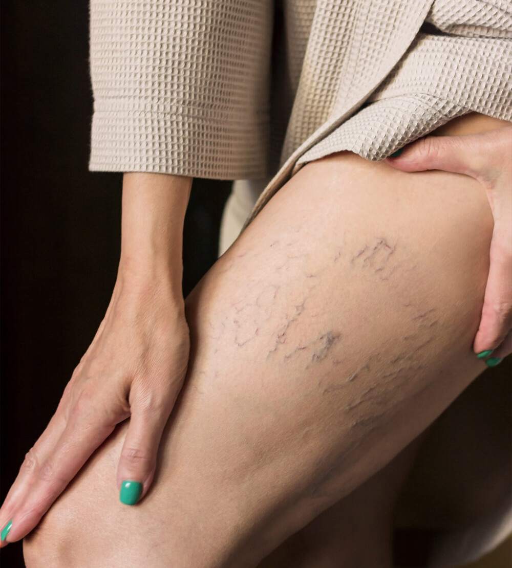 understanding leg thread veins